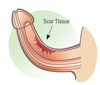 tissu cicatriciel du pénis