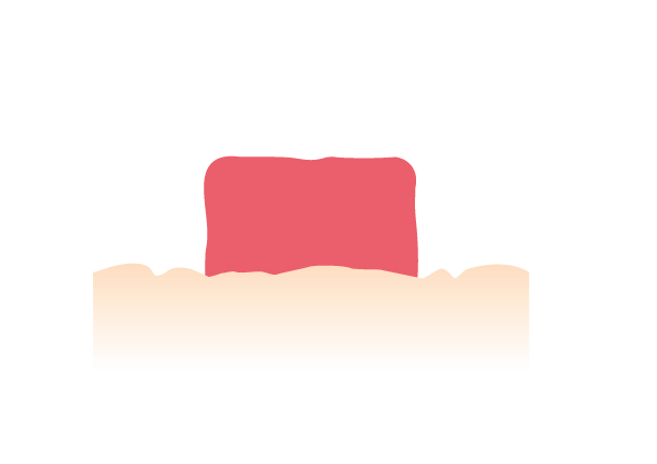 <center>Présence de plis, creux, cicatrices autour de votre stomie