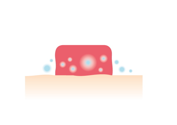 <center>Zone humide autour de votre stomie