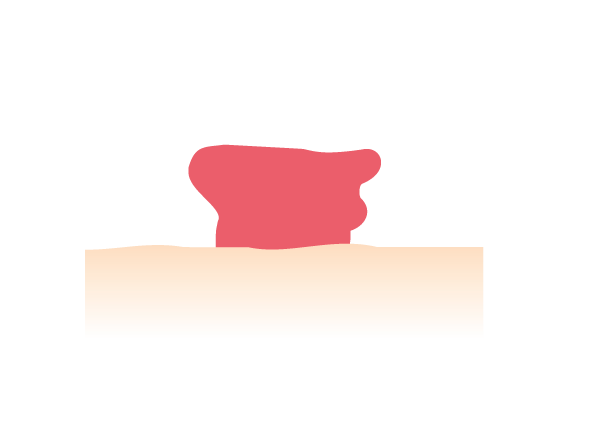<center>Forme irrégulière de votre stomie