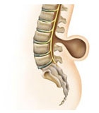 Méningocèle