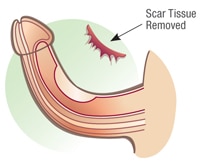 retrait du tissu cicatriciel du pénis