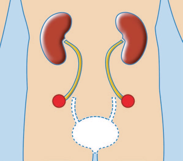 Urétérostomie bilatérale