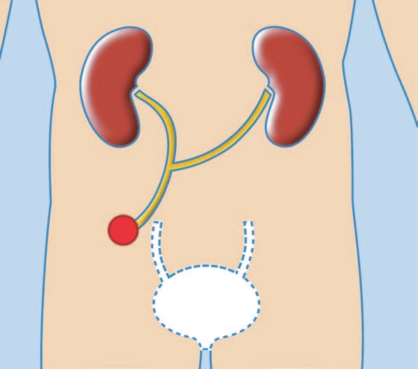 Urétérostomie unilatérale 