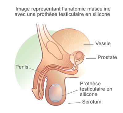 prothèse testiculaire