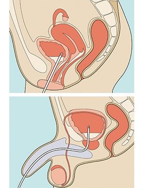 Pratiquer l'auto-sondage intermittent (hommes) - Service d'urologie - HUG