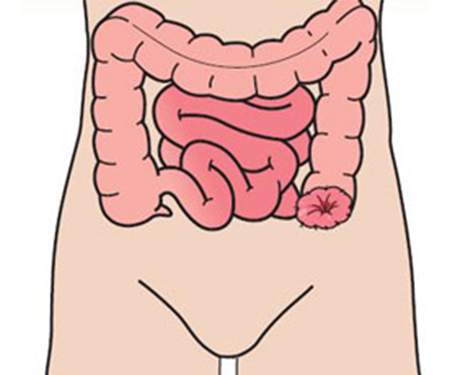 Colostomie