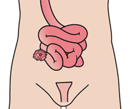 ileostomie