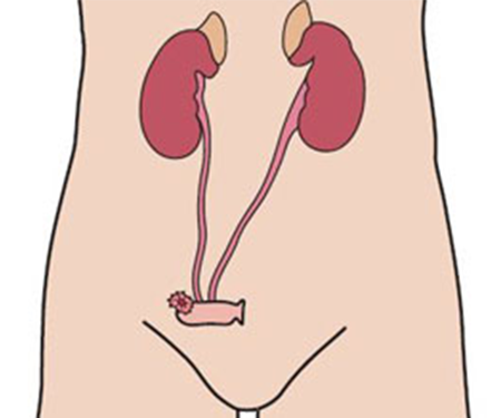 Urostomie